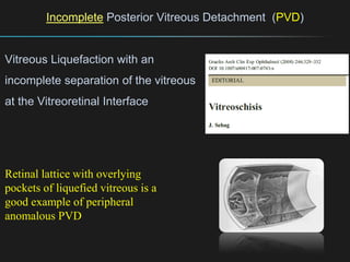 Pvd Retina Incomplete Ferrara final the vitreoretinal interface a new interest for an old ...