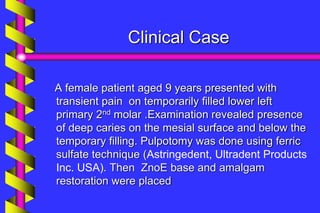 Clinical Case
A female patient aged 9 years presented with
transient pain on temporarily filled lower left
primary 2nd molar .Examination revealed presence
of deep caries on the mesial surface and below the
temporary filling. Pulpotomy was done using ferric
sulfate technique (Astringedent, Ultradent Products
Inc. USA). Then ZnoE base and amalgam
restoration were placed
 
