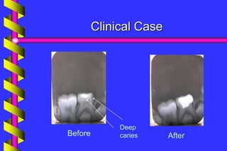 Clinical Case
Before After
Deep
caries
 