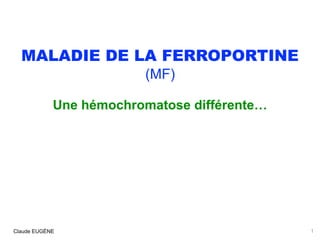 MALADIE DE LA FERROPORTINE
(MF)
Une hémochromatose différente…
Claude EUGÈNE 1
 