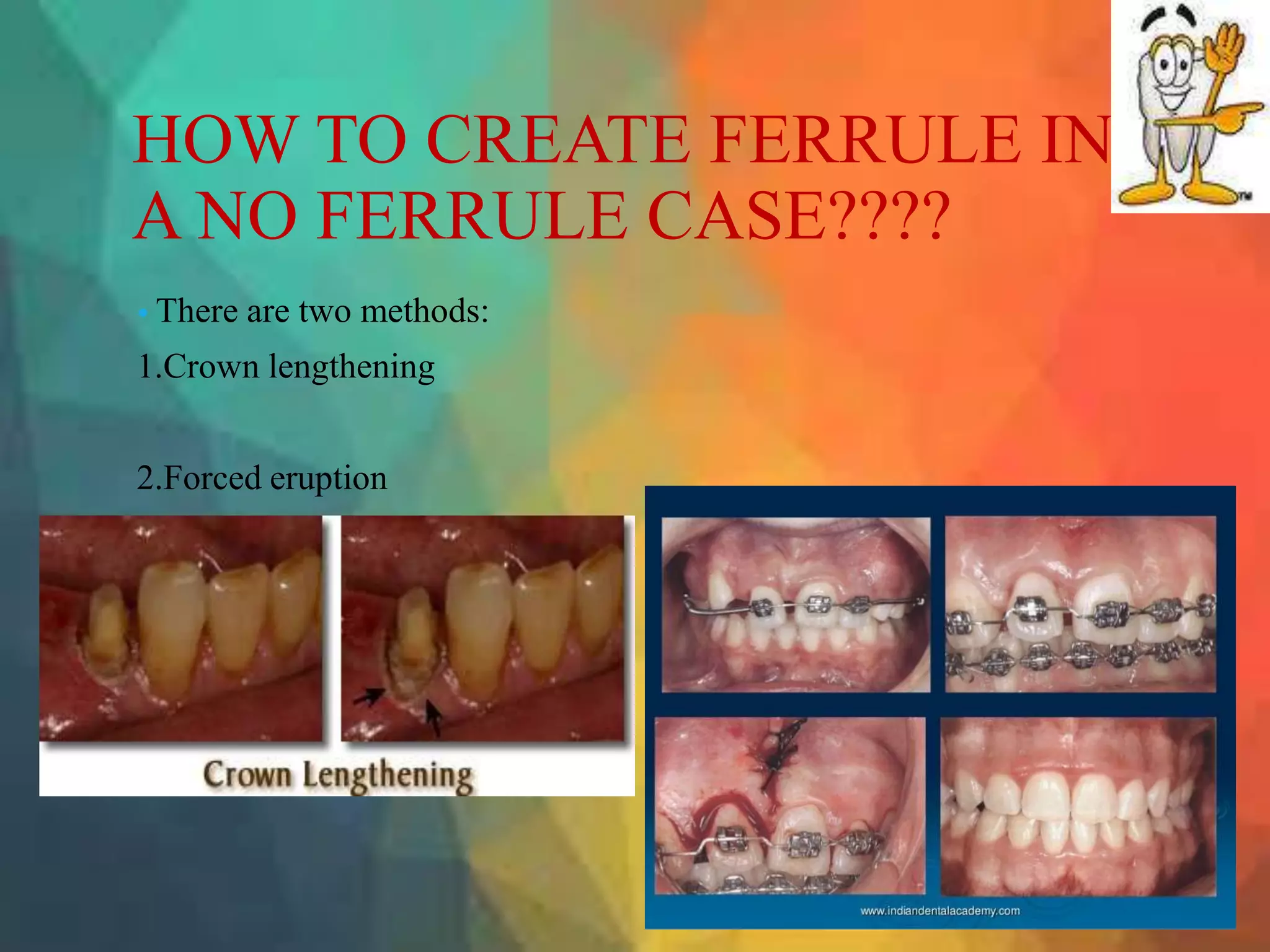 Ferrule 3 | PPTX
