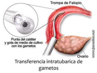 Transferencia intratubarica de
gametos
 