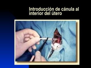 Introducción de cánula al interior del útero  