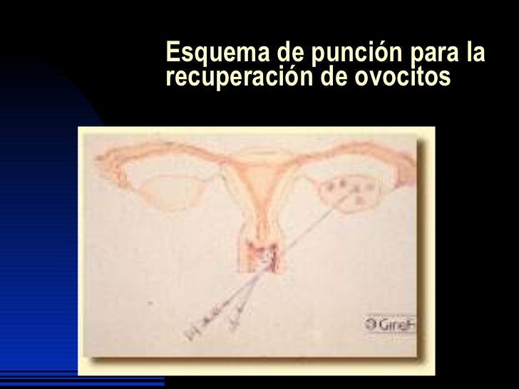 Fertilidad asistida