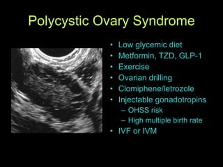 Polycystic Ovary Syndrome Low glycemic diet Metformin, TZD, GLP-1 Exercise Ovarian drilling Clomiphene/letrozole Injectable gonadotropins OHSS risk High multiple birth rate IVF or IVM 