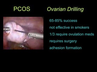 PCOS  Ovarian Drilling 65-85% success not effective in smokers 1/3 require ovulation meds requires surgery adhesion formation 