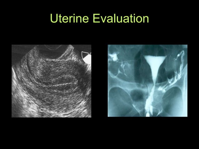 Fertility Options: IVF Overview | PPT | Free Download