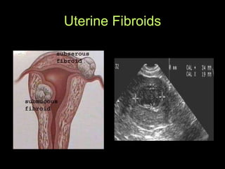 Uterine Fibroids 