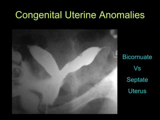 Congenital Uterine Anomalies Bicornuate Vs Septate Uterus 