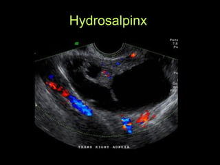 Hydrosalpinx  