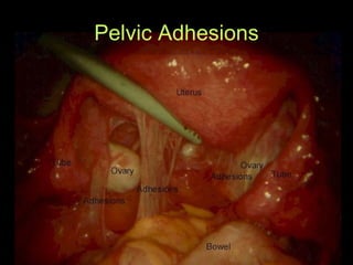 Pelvic Adhesions 
