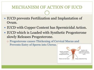 MECHANISM OF ACTION OF IUCD
 IUCD prevents Fertilization and Implantation of
Ovum.
 IUCD with Copper Content has Spermicidal Action.
 IUCD which is Loaded with Synthetic Progesterone
slowly Releases Progesterone.
 Progesterone causes Thickening of Cervical Mucus and
Prevents Entry of Sperm into Uterus.
 