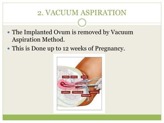 2. VACUUM ASPIRATION
 The Implanted Ovum is removed by Vacuum
Aspiration Method.
 This is Done up to 12 weeks of Pregnancy.
 