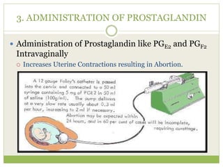 3. ADMINISTRATION OF PROSTAGLANDIN
 Administration of Prostaglandin like PGE2 and PGF2
Intravaginally
 Increases Uterine Contractions resulting in Abortion.
 