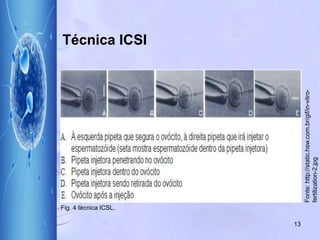 Técnica ICSI
13
Fonte:http://static.hsw.com.br/gif/in-vitro-
fertilization-2.jpg
Fig. 4 técnica ICSL.
 