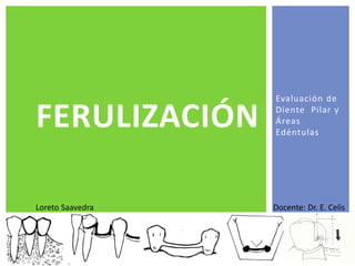 Evaluación de
Diente Pilar y
Áreas
Edéntulas
FERULIZACIÓN
Loreto Saavedra Docente: Dr. E. Celis
 