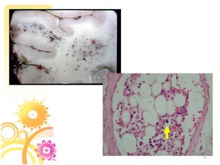 SignsPetechiae : on the head, neck, anterior thorax, subconjunctiva, and axillae.Result from the occlusion of dermal capillaries by fat globules, leading to extravasation of erythrocytes.Hypoxaemia (<8kPa/60 mmHg) is suspicious7