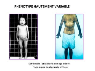 Début dans l’enfance ou à un âge avancé
•Age moyen du diagnostic : 21 ans
PHÉNOTYPE HAUTEMENT VARIABLE
 