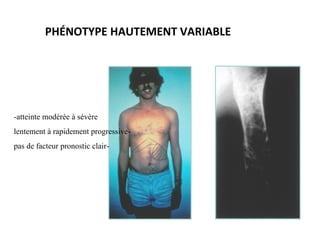 -atteinte modérée à sévère
-lentement à rapidement progressive
-pas de facteur pronostic clair
PHÉNOTYPE HAUTEMENT VARIABLE
 