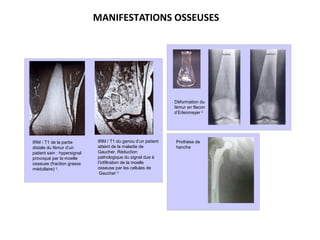 MANIFESTATIONS OSSEUSES
Prothèse de
hanche
IRM / T1 du genou d’un patient
atteint de la maladie de
Gaucher. Réduction
pathologique du signal due à
l’infiltration de la moelle
osseuse par les cellules de
Gaucher 3
.
IRM / T1 de la partie
distale du fémur d’un
patient sain : hypersignal
provoqué par la moelle
osseuse (fraction grasse
médullaire) 3
.
Déformation du
fémur en flacon
d’Erlenmeyer 2
 