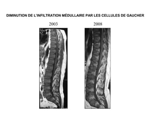 2003 2008
DIMINUTION DE L’INFILTRATION MÉDULLAIRE PAR LES CELLULES DE GAUCHER
 