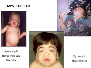MPS I : HURLER
Hépatomégalie
Hernie ombilicale
Diarrhées
Dysmorphie
Hydrocéphalie
Obstruction nasale
Apnées du sommeil
 