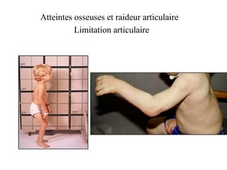 Atteintes osseuses et raideur articulaire
Limitation articulaire
 