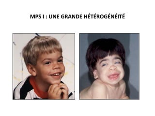 MPS I : UNE GRANDE HÉTÉROGÉNÉITÉ
Forme atténuée Forme sévère
 