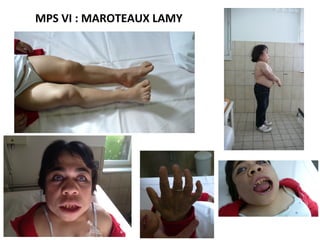 MPS VI : MAROTEAUX LAMY
 