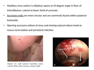 Accessory Ostium FESS.pptxgttyyyyyyyyyyyyggyggggggggggyyy | PPTX