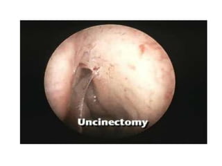 Fess complications presentation