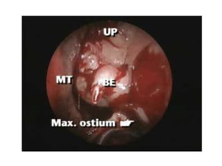 Fess complications presentation