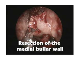 Fess complications presentation