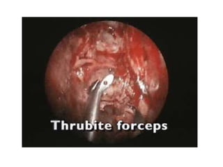 Fess complications presentation