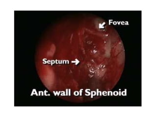 Fess complications presentation