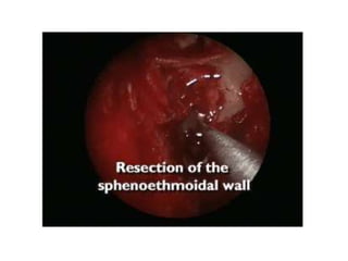 Fess complications presentation