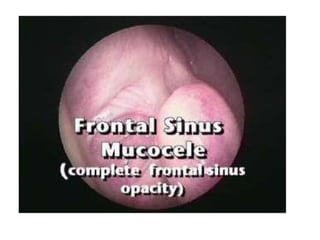 Fess complications presentation