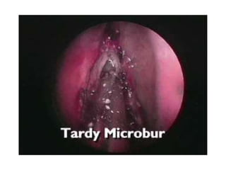 Fess complications presentation