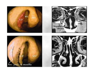 Fess complications presentation