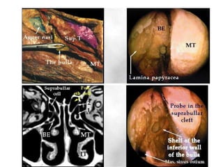 Fess complications presentation