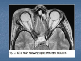 Fess complications presentation