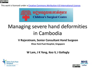 Managing severe hand deformities
in Cambodia
V Rajaratnam, Senior Consultant Hand Surgeon
Khoo Teck Puat Hospital, Singapore
W Lam, J K Yong, Keo V, J Gollogly
This work is licensed under a Creative Commons Attribution 4.0 International License.
 