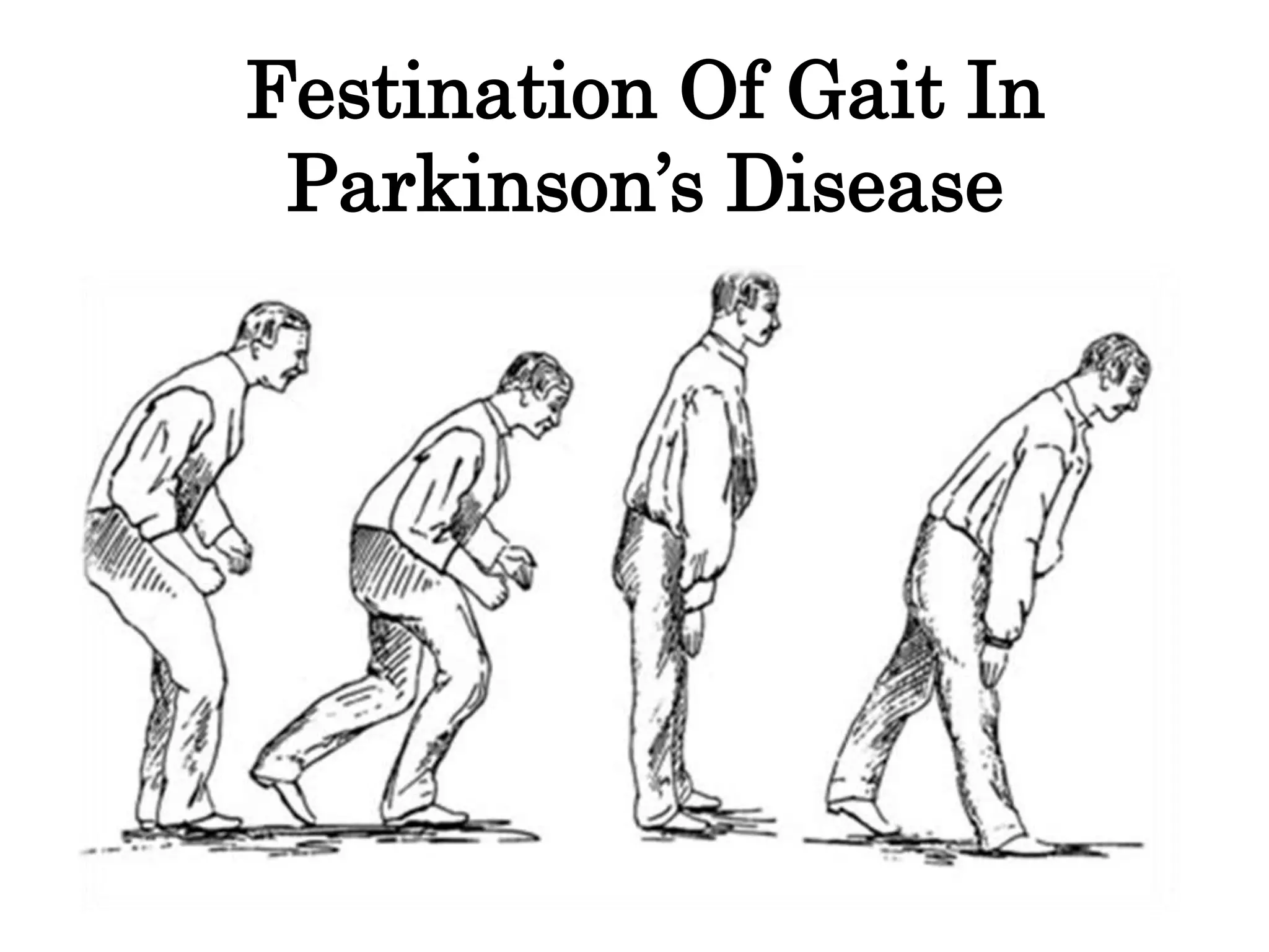 Festinating Festination Of Gait In Parkinson’s Disease | PPTX