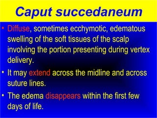 Caput succedaneum 
• Diffuse, sometimes ecchymotic, edematous 
swelling of the soft tissues of the scalp 
involving the portion presenting during vertex 
delivery. 
• It may extend across the midline and across 
suture lines. 
• The edema disappears within the first few 
days of life. 
 