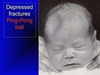 Depressed 
fractures 
Ping-Pong 
ball 
 