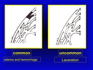 common uncommon 
edema and hemorrhage Laceration 
 
