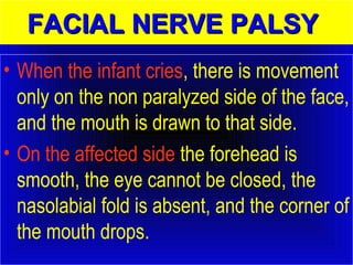 FFAACCIIAALL NNEERRVVEE PPAALLSSYY 
• When the infant cries, there is movement 
only on the non paralyzed side of the face, 
and the mouth is drawn to that side. 
• On the affected side the forehead is 
smooth, the eye cannot be closed, the 
nasolabial fold is absent, and the corner of 
the mouth drops. 
 