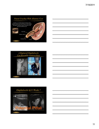 7/19/2011




     Patent Urachus With Allantoic Cyst
   Urachus is an embryological remnant of the
allantois which runs from the apex of the bladder
  through the umbilical ring to terminate in the
             proximal umbilical cord




                         Yolk Stalk


                    Allantoic Stalk




                       Umbilical Cord
                                          Cloaca
    Fetal Abdomen




              A Ruptured Omphalocele
             Can Resemble Gastroschisis




    Fetal Abdomen




           Omphalocele @11 Weeks ?




        Potential Pitfall
    Fetal Abdomen




                                                          11
 