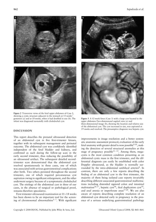 862                                                                                                                   Sepulveda et al.




Figure 2 Transverse views of the fetal upper abdomen of Case 2,
showing a cystic structure adjacent to the stomach at 13 weeks’
gestation (a) and at 18 weeks, when it had doubled in size (b). The   Figure 3 A 12-week fetus (Case 3) with a large cyst located in the
infant was diagnosed neonatally with choledochal cyst.                upper abdomen.Two-dimensional sagittal view (a) and
                                                                      three-dimensional image (b), showing the location and relative size
                                                                      of the abdominal cyst. The cyst increased in size, was aspirated at
                                                                      19 weeks and resolved. The presumptive diagnosis was hepatic cyst.
DISCUSSION

This report describes the prenatal ultrasound detection
                                                                      improvements in image resolution and a better system-
of an abdominal cyst in ﬁve ﬁrst-trimester fetuses,
                                                                      atic anatomic assessment protocol, evaluation of the early
together with its subsequent management and perinatal
                                                                      fetal anatomy with greater detail is now possible9,10 , mak-
outcome. The abdominal cyst was conﬁdently identiﬁed
independent of the fetal bladder and kidneys, and                     ing the detection of several structural anomalies at this
conﬁrmed as such during the follow-up scan in the                     stage of pregnancy possible11 – 15 . Among them, mega-
early second trimester, thus reducing the possibility of              cystis is the most common condition presenting as an
an ultrasound artifact. The subsequent detailed second-               abdominal cystic mass in the ﬁrst trimester, and the dif-
trimester scan demonstrated that the abdominal cyst                   ferential diagnosis can easily be established with color
resolved spontaneously in three cases, one of which                   Doppler ultrasound, as the bladder is normally sur-
was associated with serious gastrointestinal complications            rounded by the intra-abdominal umbilical arteries8 . In
after birth. Two others persisted throughout the second               contrast, there are only a few reports describing the
trimester, one of which required percutaneous cyst                    ﬁnding of an abdominal cyst in the ﬁrst trimester, the
aspiration owing to signiﬁcant enlargement, and the other             majority of them being isolated case reports invariably
underwent surgery because of a symptomatic choledochal                describing different associated gastrointestinal malforma-
cyst. The etiology of the abdominal cyst in three of our              tions including distended sigmoid colon and intestinal
cases, in the absence of surgical or pathological proof,              malrotation16,17 , hepatic cyst18 , ileal duplication cyst19 ,
remains therefore speculative.                                        and anal atresia or imperforate anus17,20 . We are also
   First-trimester ultrasound examination at 11–14 weeks              aware of reports describing complete resolution of an
has been shown to be an important tool for the screen-                abdominal cyst detected early in pregnancy in the pres-
ing of chromosomal abnormalities5 – 7 . With signiﬁcant               ence of a serious underlying gastrointestinal pathology


Copyright  2008 ISUOG. Published by John Wiley & Sons, Ltd.                            Ultrasound Obstet Gynecol 2008; 32: 860–864.
 