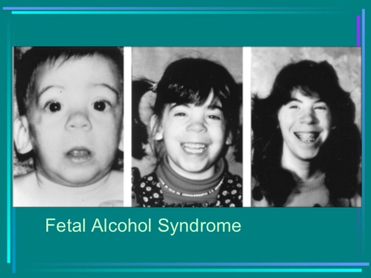 Фетально алкогольный синдром. Фетальный алкогольный синдром. Взрослые люди с фетальным алкогольным синдромом. ФАС фетальный алкогольный синдром.
